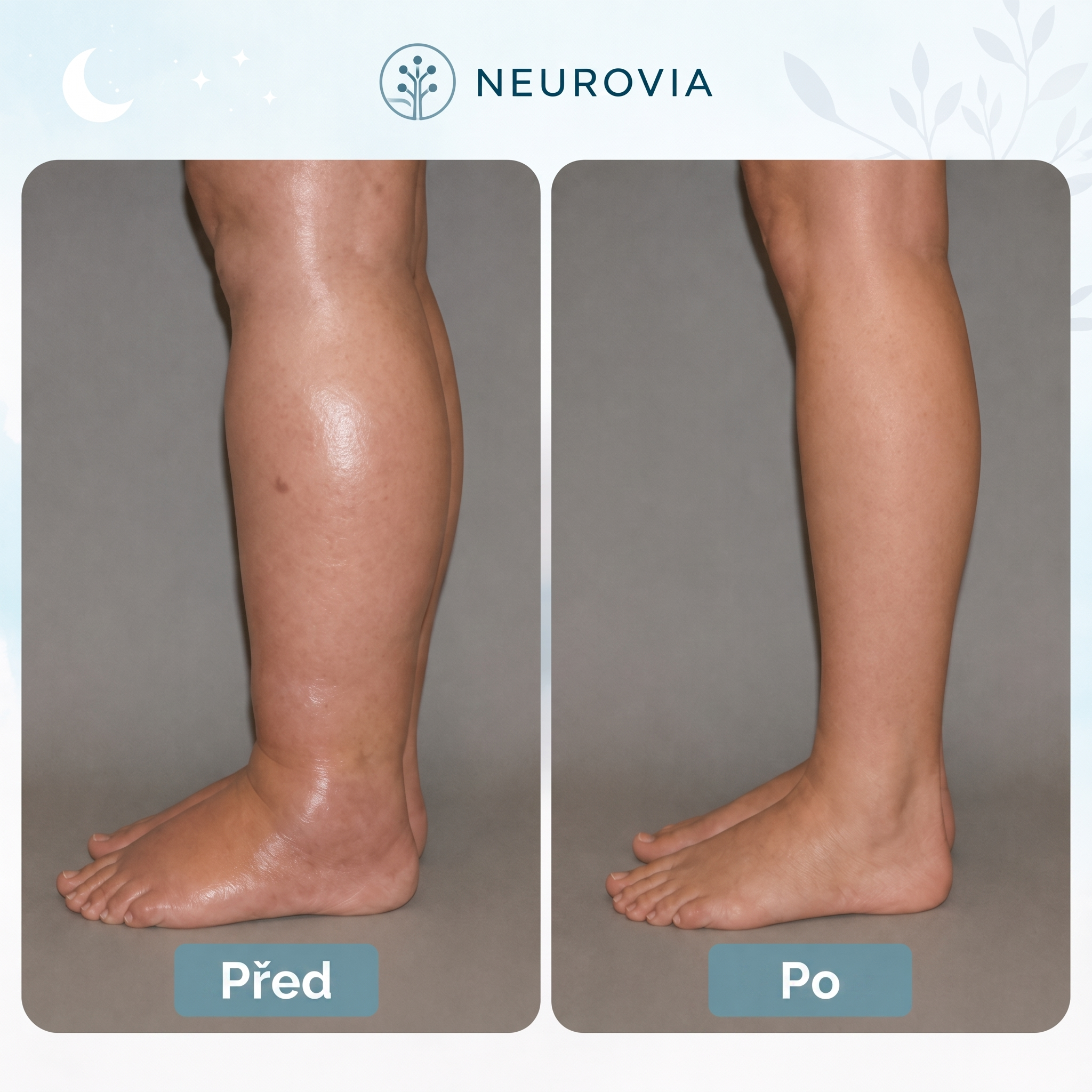 Neurovia™ EMS aktivátor nohou pro nateklé, těžké nebo oslabené nohy – pro domácí použití.